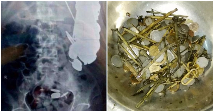 Dikira keracunan, isi perut pria ini ternyata paku dan koin