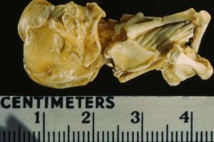 Mengeluh perut sakit, wanita ini ternyata mengandung janin 15 tahun