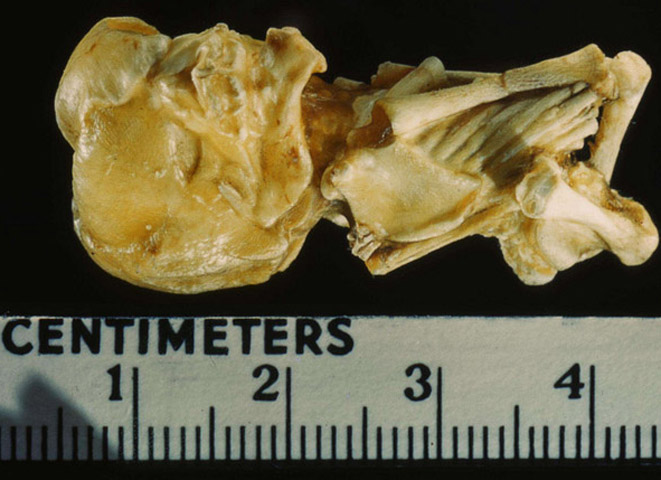 Mengeluh perut sakit, wanita ini ternyata mengandung janin 15 tahun