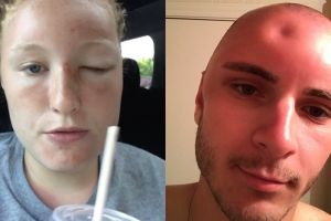 Wajah 4 orang ini bengkak terbakar sinar matahari, ada yang penyok