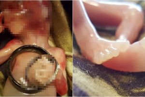 Kisah pilu wanita unggah foto janinnya usai keguguran