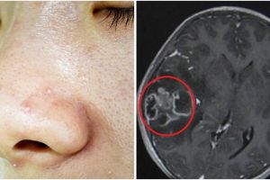 Duh, anak 10 tahun ini derita infeksi otak usai komedonya dipencet