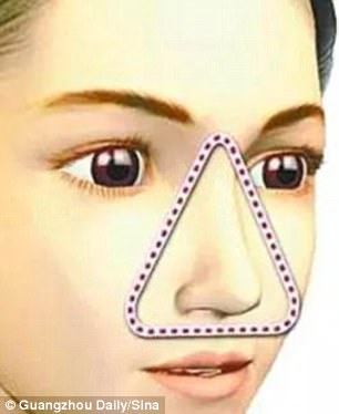 Duh, anak 10 tahun ini derita infeksi otak usai komedonya dipencet