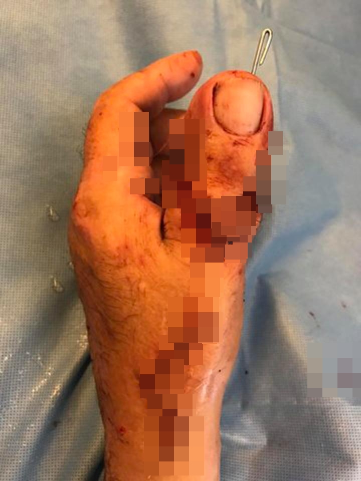 Jempol tangan pria ini diganti jempol kaki setelah kecelakaan