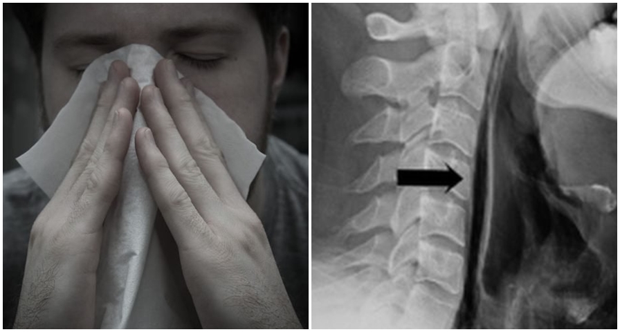 Sering tahan bersin, tenggorokan pria ini akhirnya pecah