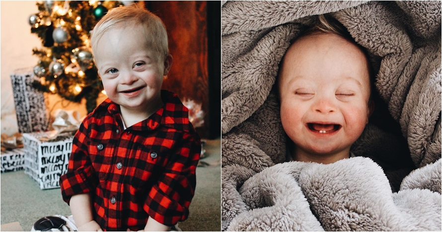 10 Potret Case, bayi penderita down syndrome yang ngegemesin banget