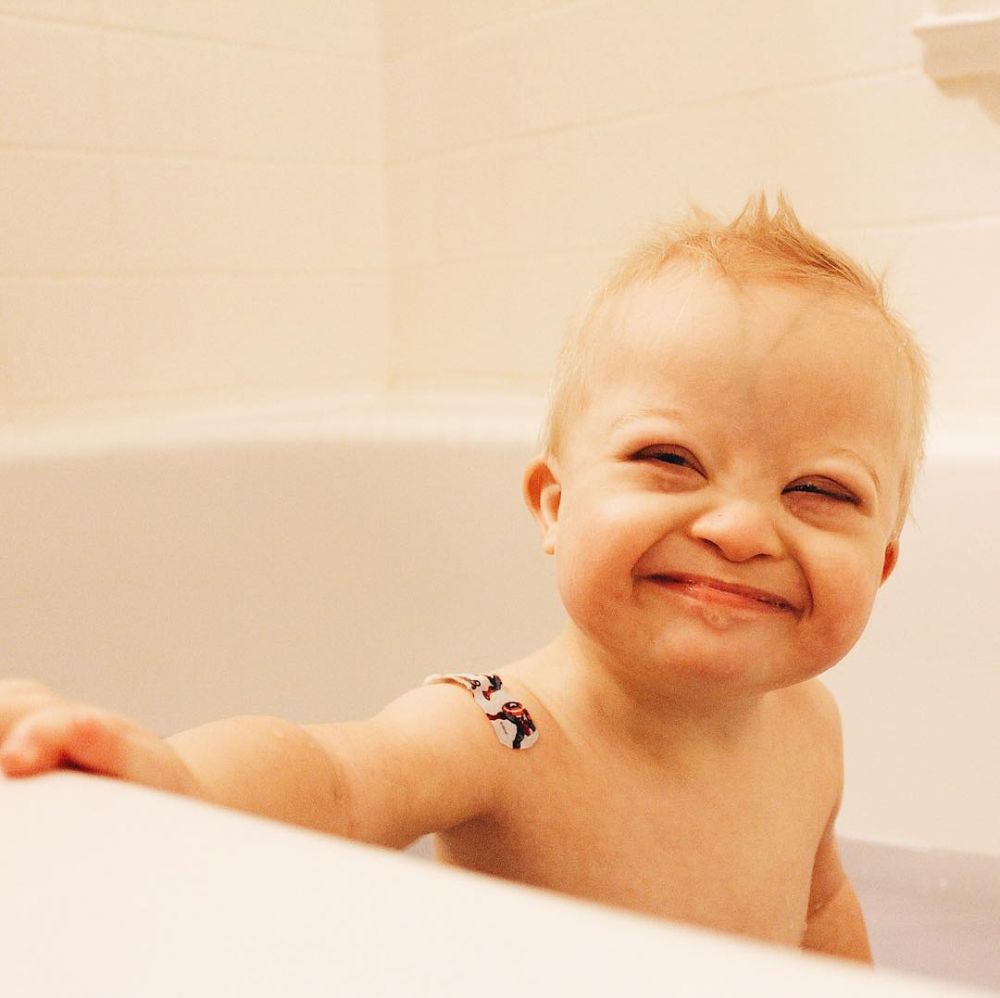 10 Potret Case, bayi penderita down syndrome yang ngegemesin banget