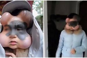 Ada 4 benjolan di wajah wanita ini, fakta di baliknya ngeri banget