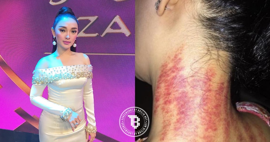 Gaya 10 selebriti yang diam-diam suka kerokan, obat masuk angin nih