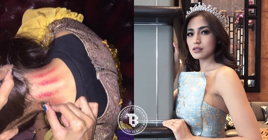 Gaya 10 selebriti yang diam-diam suka kerokan, obat masuk angin nih