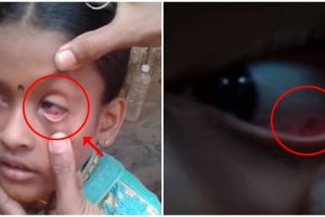 Diduga kena kutuk, mata bocah ini keluarkan 60 ekor semut