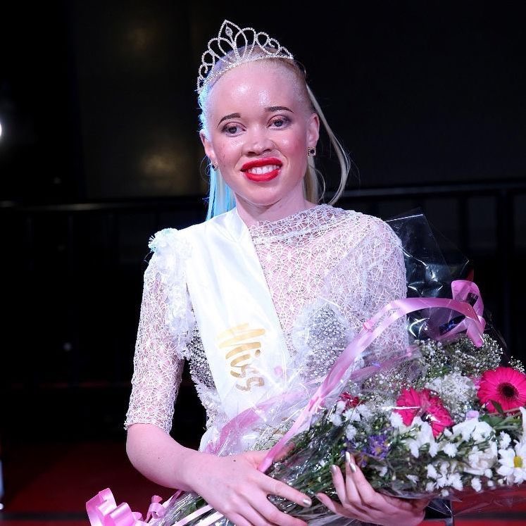 7 Pesona cantiknya Sithembiso Mutukura, Miss Albino asal Zimbabwe