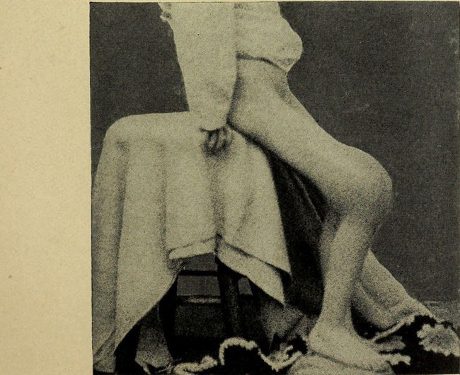 4 Potret mengerikan efek radium yang jadi bahan kecantikan zaman dulu