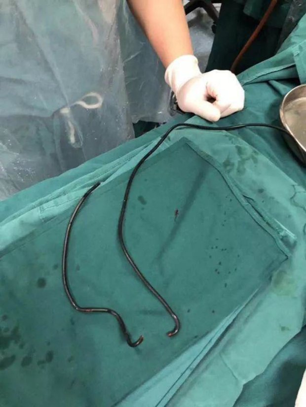 Alat kelamin pria ini harus dioperasi gara-gara kabel charger HP