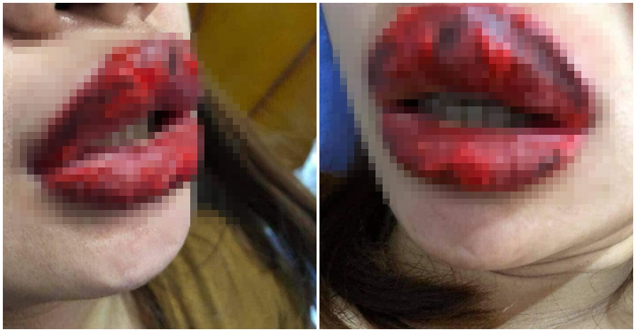 3 Hari pakai lipstik palsu, bibir wanita ini berubah mengerikan