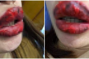 3 Hari pakai lipstik palsu, bibir wanita ini berubah mengerikan