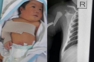 Potret miris bayi baru lahir yang alami patah tulang lengan