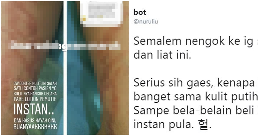 Kisah ngeri wanita kulitnya rusak usai pakai lotion pemutih