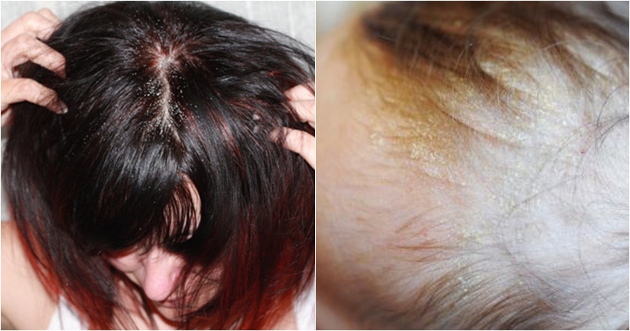 10 Kepala penuh ketombe ini menjijikkan banget, nggak pernah keramas?