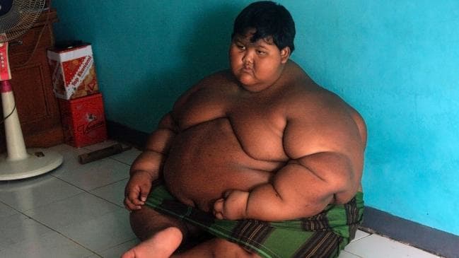 Ingat Arya Permana, bocah berbobot 188 kg? Kondisinya kini bikin kaget