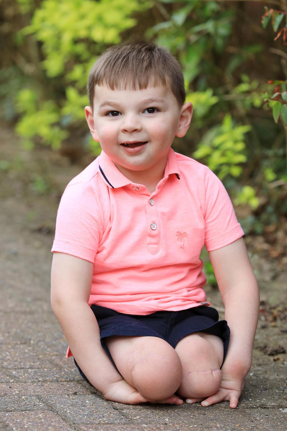 Dianiaya orangtuanya, balita ini dirawat 41 hari dan akhirnya lumpuh