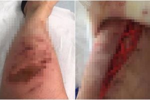 Tak sengaja terkena tumbuhan beracun, kaki pria ini hampir diamputasi