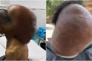 Selama 47 tahun, pria ini menderita tumor seberat 14,9 kilogram