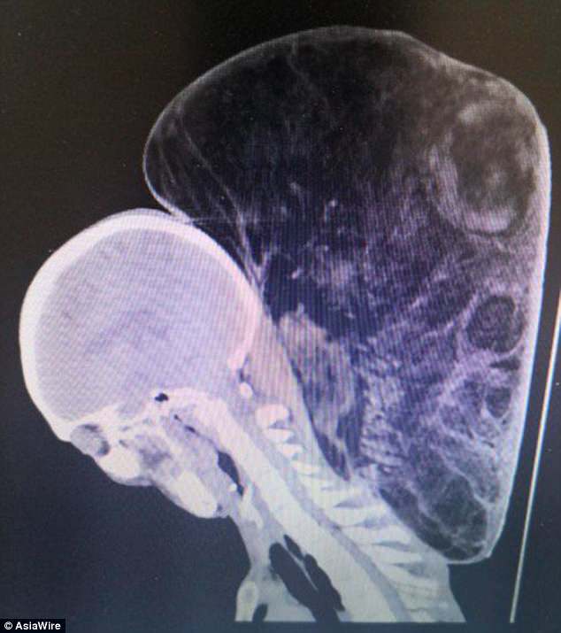 Selama 47 tahun, pria ini menderita tumor seberat 14,9 kilogram