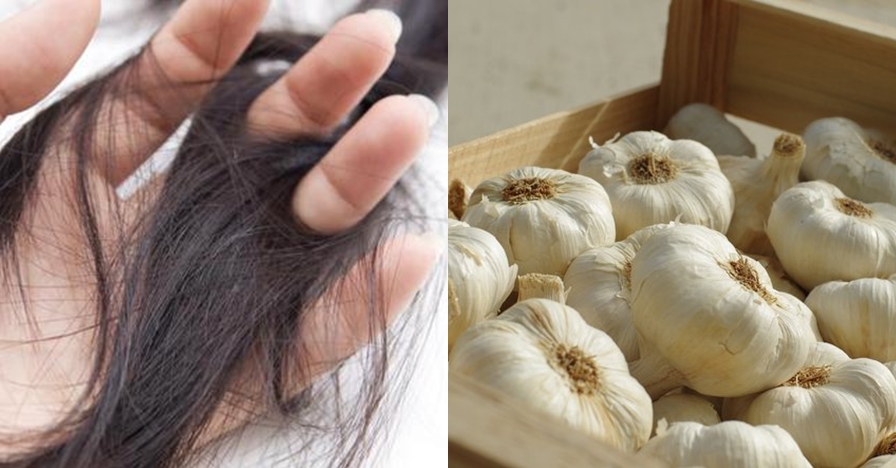 Penemuan menakjubkan! Bawang putih ternyata ampuh atasi rambut rontok