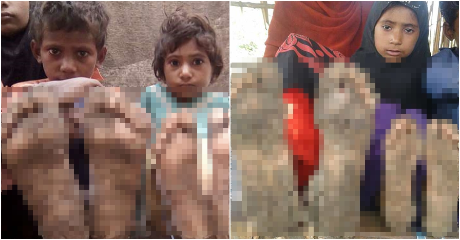 Terkena penyakit langka, kondisi kaki 3 anak ini berubah mengerikan