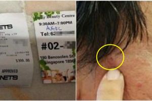 Tergiur harga promo laser tahi lalat, begini nasib pria 52 tahun ini