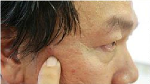 Tergiur harga promo laser tahi lalat, begini nasib pria 52 tahun ini