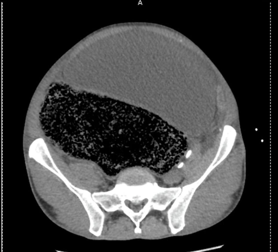 Tahan buang air besar selama 4 minggu, cowok ini nyaris lumpuh