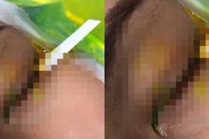 Tergiur harga softlens Rp 70 ribu, kondisi mata wanita ini hampir buta