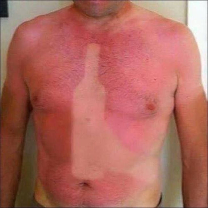 8 Pola kulit belang gara-gara sinar matahari ini nyeseknya di dada