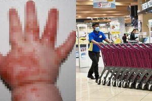 Tertular virus dari troli belanja, tangan bayi ini berubah mengerikan