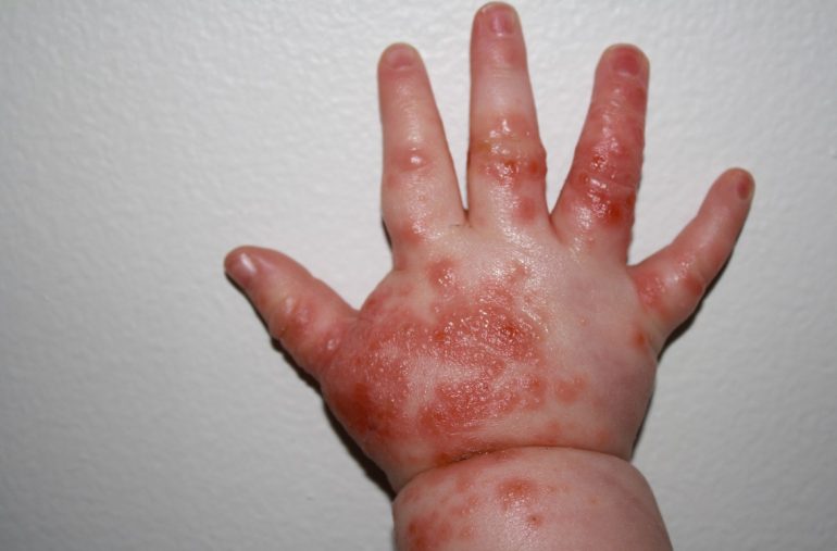 Tertular virus dari troli belanja, tangan bayi ini berubah mengerikan