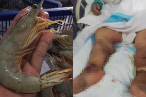 Gara-gara tertusuk duri ekor udang, nasib wanita ini berakhir tragis