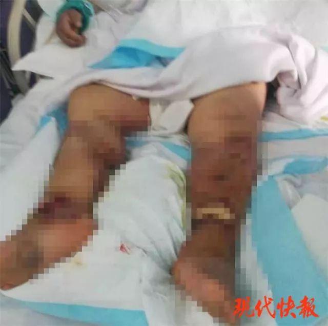 Gara-gara tertusuk duri ekor udang, nasib wanita ini berakhir tragis