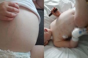 Dikira masuk angin, fakta di balik perut  balita membesar ini ngeri