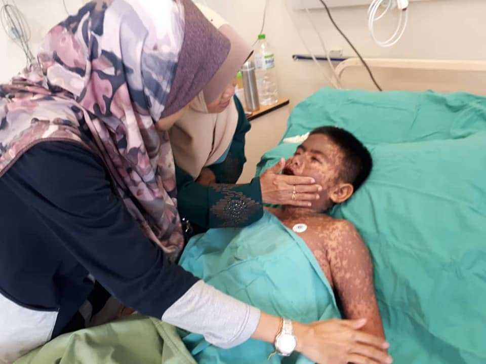 Gara-gara alergi obat antibiotik, kondisi kulit bocah ini bikin syok