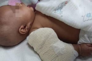 Diduga dianiaya pengasuh, bayi 3 bulan ini alami patah tulang lengan