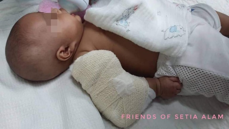 Diduga dianiaya pengasuh, bayi 3 bulan ini alami patah tulang lengan