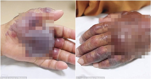 Gara-gara makan sushi, kondisi tangan pria ini berakhir mengerikan