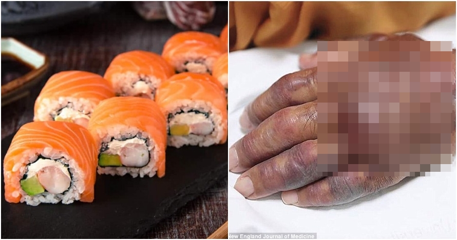 Gara-gara makan sushi, kondisi tangan pria ini berakhir mengerikan