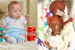 Kisah Theo Taylor, bayi seukuran kaleng soda yang bertahan hidup