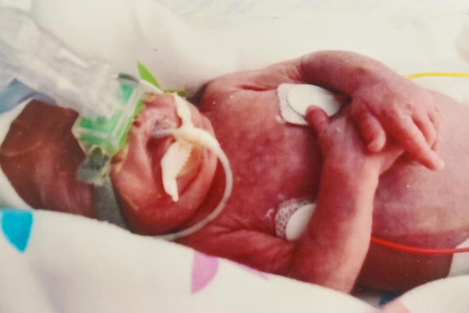 Kisah Theo Taylor, bayi seukuran kaleng soda yang bertahan hidup