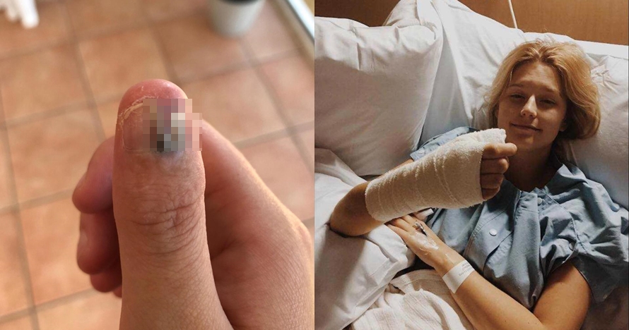 Hobi gigit kuku, jari gadis ini terpaksa diamputasi