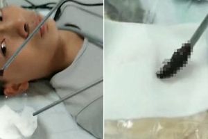 Pria ini mimisan selama 10 hari, penyebabnya benar-benar tak terduga