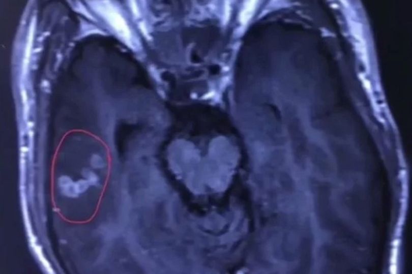 Cacing 10 cm ditemukan dalam otak pria ini, penyebabnya tak disangka